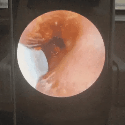 Cure-oreille caméra